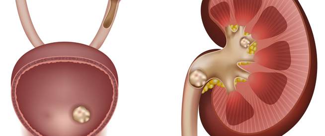 الصمغ العربى | الصمغ العربي مدر للبول ويقلل من احتباس السوائل بالجسم الصمغ العربي مدر للبول ويقلل من احتباس السوائل بالجسم